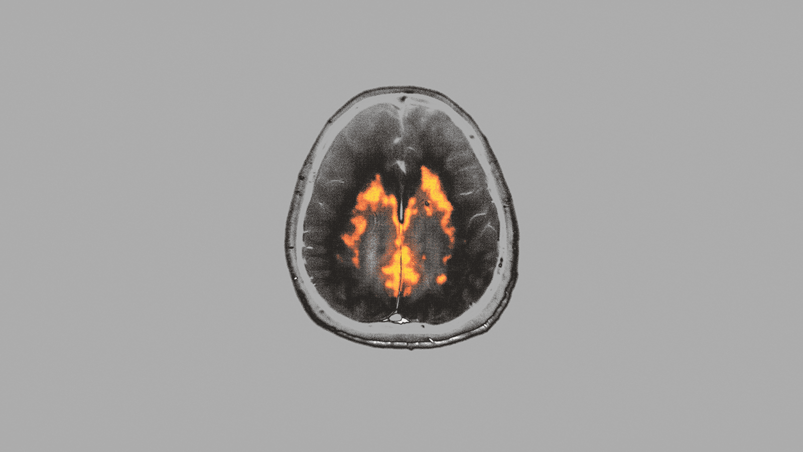 Neural Overdrive